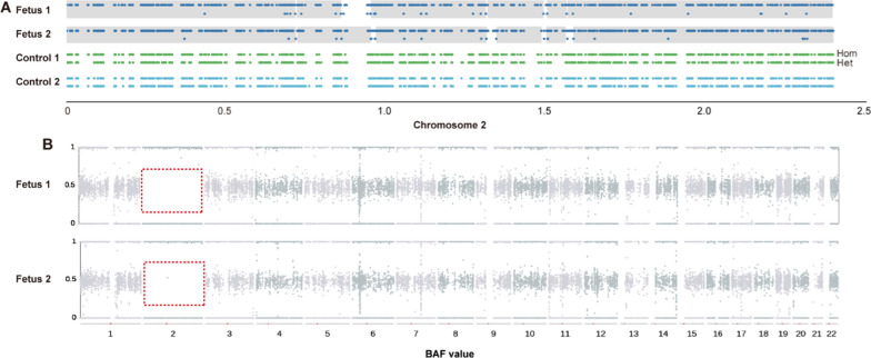 Prenatal diagnosis of paternal uniparental disomy for chromosome 2 in two fetuses with intrauterine growth restriction.