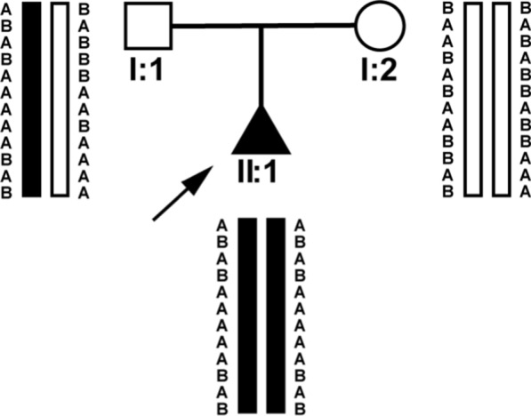 Prenatal diagnosis of paternal uniparental disomy for chromosome 2 in two fetuses with intrauterine growth restriction.