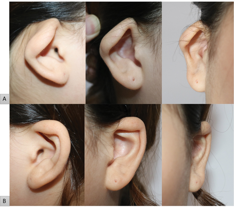 Correction of Mild-to-Moderate Constricted Ear Abnormality Using Mustardé Suture, Cartilage Onlay Graft, and Transposition Flap: A Case Report.