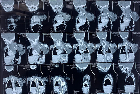 Mode of Mechanical Ventilation in a Case of Venolymphatic Malformation: Spontaneous-Saves, Positive-Precludes.