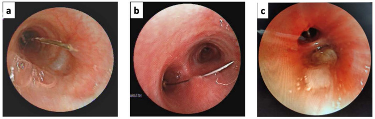 Role of Flexible Bronchoscopy using Biopsy Forceps as the Initial Attempt for Headscarf Pin Aspiration Extraction.