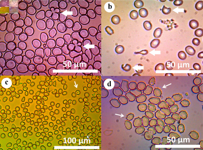 Hemolytic Anemia Requiring Splenectomy in Leigh-Like Syndrome due to the Variant m.10191T>C in <i>MT</i>-<i>ND3</i>.