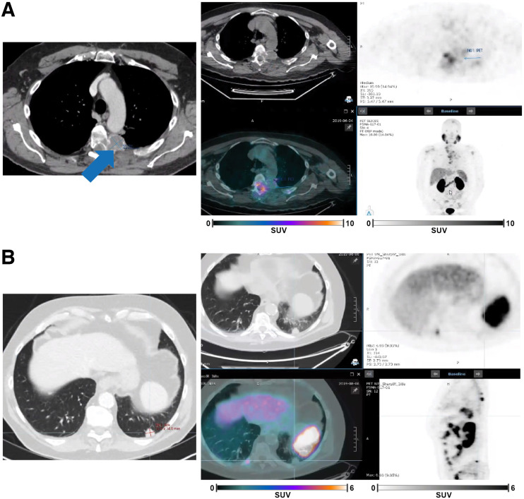 A VISION Substudy of Reader Agreement on <sup>68</sup>Ga-PSMA-11 PET/CT Scan Interpretation to Determine Patient Eligibility for <sup>177</sup>Lu-PSMA-617 Radioligand Therapy.