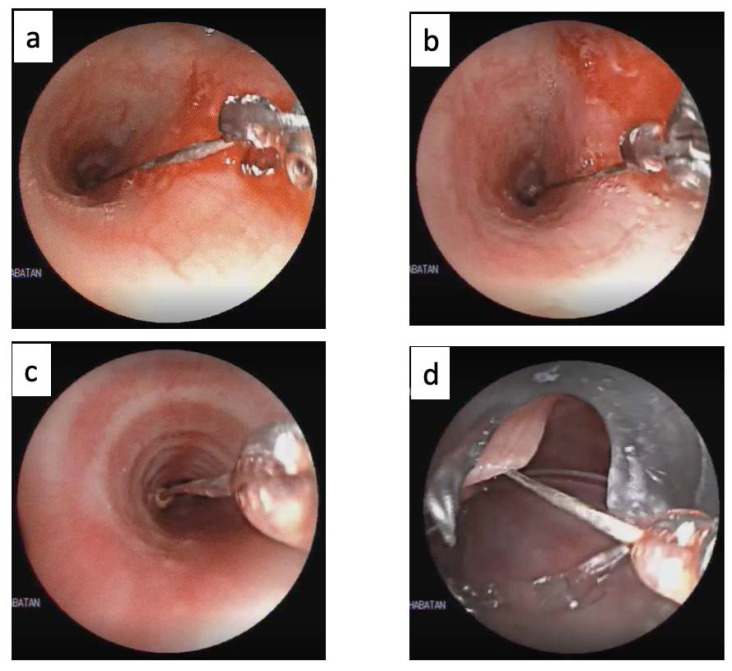 Role of Flexible Bronchoscopy using Biopsy Forceps as the Initial Attempt for Headscarf Pin Aspiration Extraction.