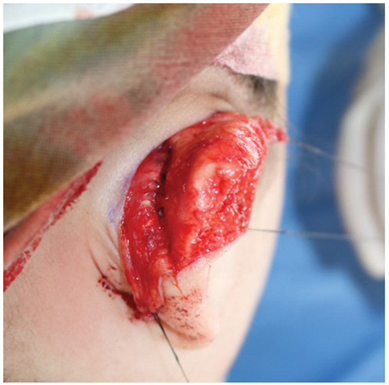 Correction of Mild-to-Moderate Constricted Ear Abnormality Using Mustardé Suture, Cartilage Onlay Graft, and Transposition Flap: A Case Report.