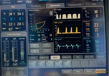 Mode of Mechanical Ventilation in a Case of Venolymphatic Malformation: Spontaneous-Saves, Positive-Precludes.