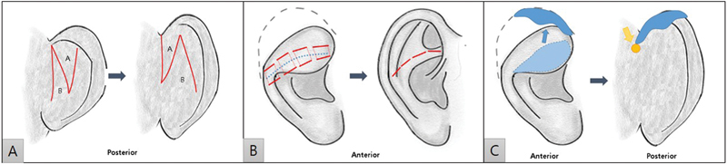 Correction of Mild-to-Moderate Constricted Ear Abnormality Using Mustardé Suture, Cartilage Onlay Graft, and Transposition Flap: A Case Report.