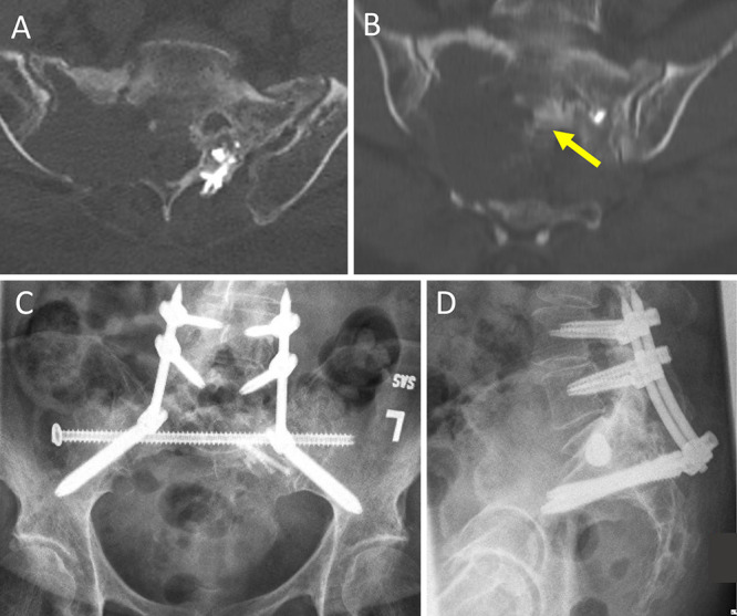 Percutaneous lumbopelvic fixation for pathologic sacral fractures and spinopelvic dissociation: patient series.