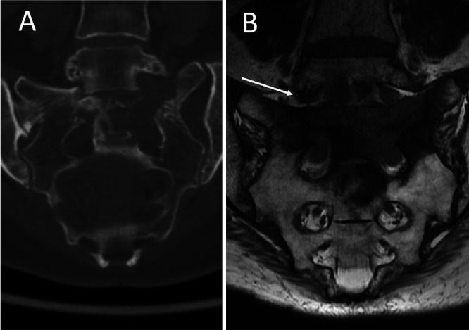 Percutaneous lumbopelvic fixation for pathologic sacral fractures and spinopelvic dissociation: patient series.