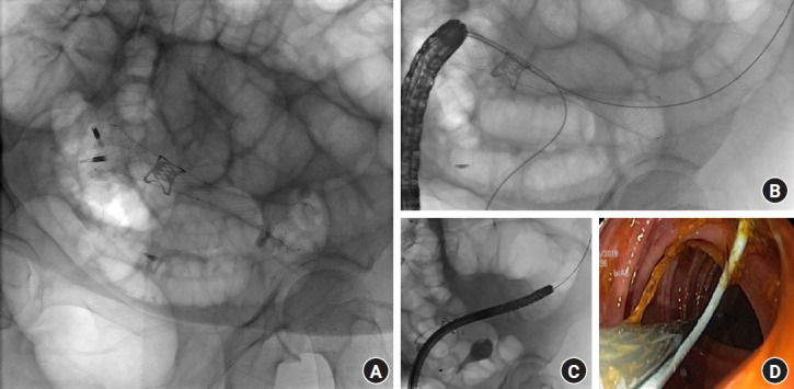 A case report of a colouterine fistula treatment: when the patient chooses the steeplechase.