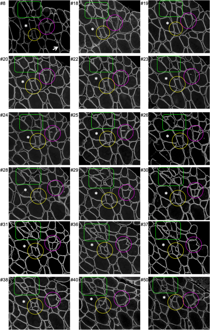 Fusion of myofibre branches is a physiological feature of healthy human skeletal muscle regeneration.