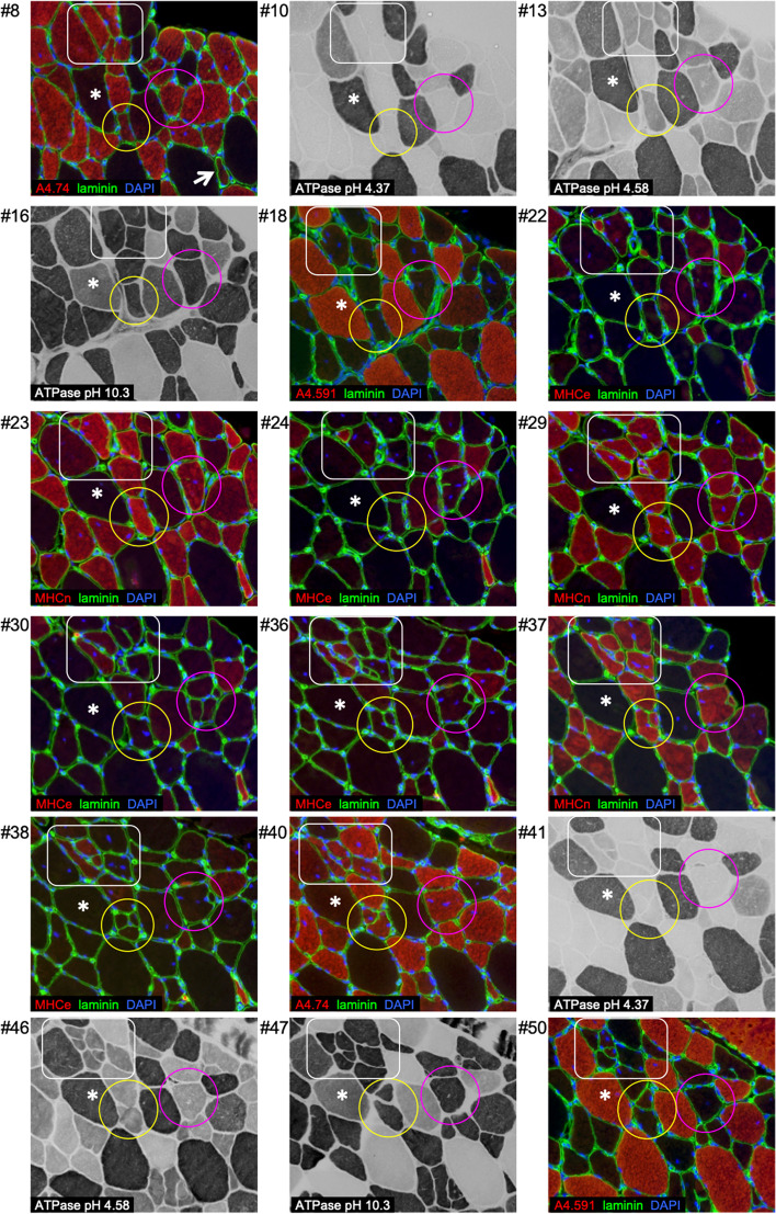 Fusion of myofibre branches is a physiological feature of healthy human skeletal muscle regeneration.