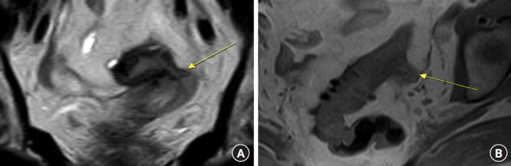 A case report of a colouterine fistula treatment: when the patient chooses the steeplechase.