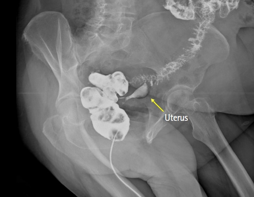 A case report of a colouterine fistula treatment: when the patient chooses the steeplechase.