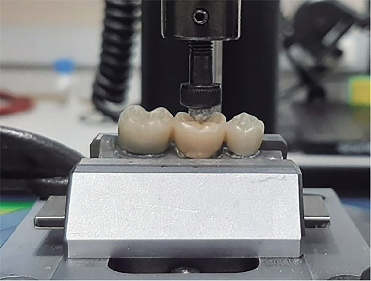 Effect of connector configuration on the fracture load in conventional and translucent zirconia three-unit fixed dental prostheses.