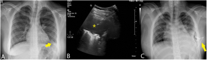 Two cases of Prevotella oris causing serious pleuropulmonary infections.