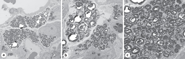 Fabry Disease Presenting as End-Stage Kidney Disease.