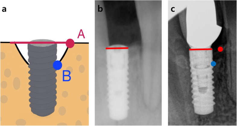 Clinical outcome of narrow diameter dental implants: a 3-year retrospective study.