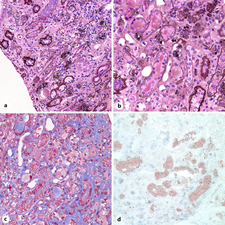 Fabry Disease Presenting as End-Stage Kidney Disease.