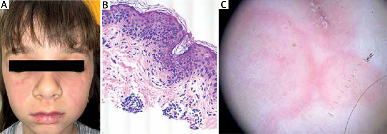 Successful treatment of a child's lupus erythematosus tumidus with antimalarials.