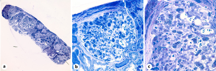 Fabry Disease Presenting as End-Stage Kidney Disease.