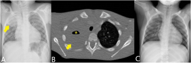 Two cases of Prevotella oris causing serious pleuropulmonary infections.