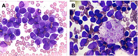 <i>HNRNPC-RARA</i> Fusion Gene in a Case with Acute Promyelocytic Leukemia Lacking <i>PML-RARA</i> Rearrangement Presenting with Abundant Hemophagocytosis