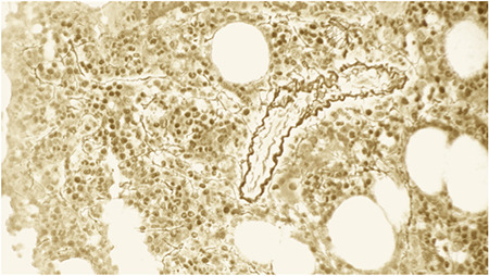 Autoinflammation and Myelofibrosis: Report of a Case