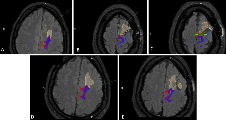 Connectomics as a prognostic tool of functional outcome in glioma surgery of the supplementary motor area: illustrative case.