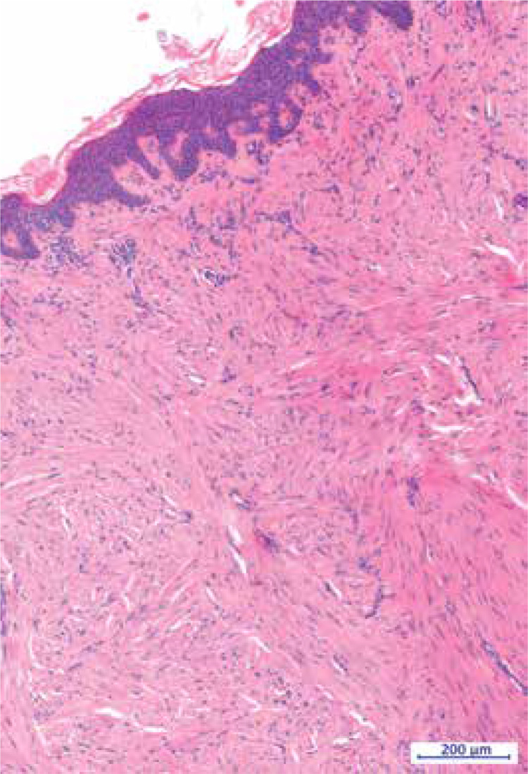 Multiple segmental piloleiomyoma: unrecognised entity.