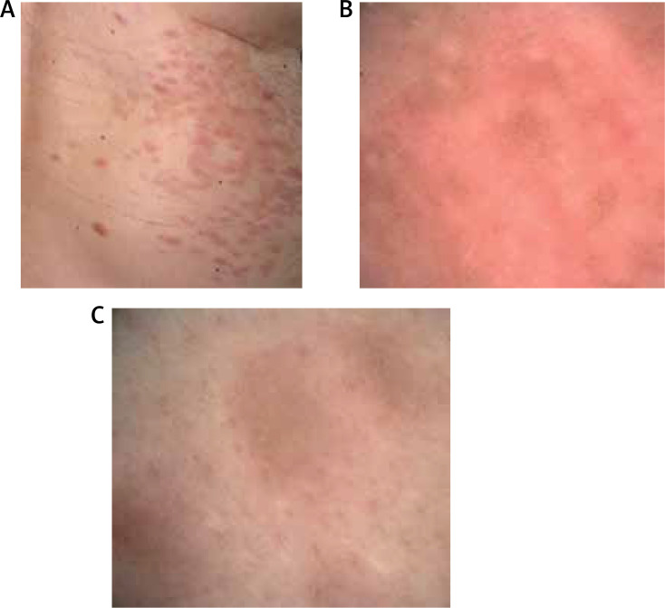 Multiple segmental piloleiomyoma: unrecognised entity.