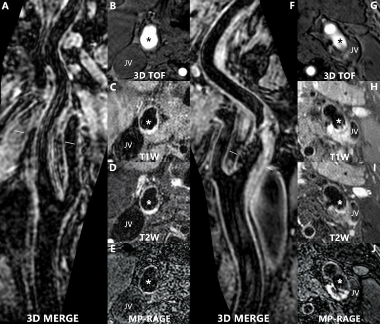 Differences in left and right carotid plaque vulnerability in patients with bilateral carotid plaques: a CARE-II study.