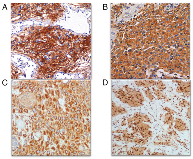 Clinicopathological significance of concurrent ErbB receptor expression in human meningioma.