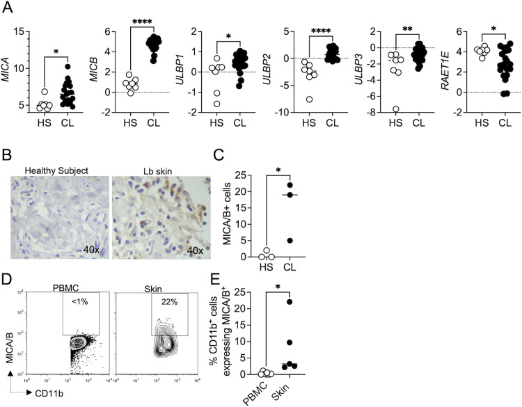 NKG2D promotes CD8 T cell-mediated cytotoxicity and is associated with treatment failure in human cutaneous leishmaniasis.