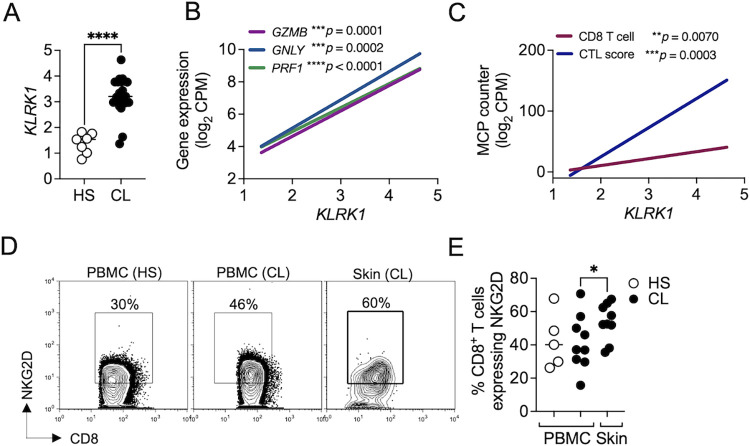 NKG2D promotes CD8 T cell-mediated cytotoxicity and is associated with treatment failure in human cutaneous leishmaniasis.