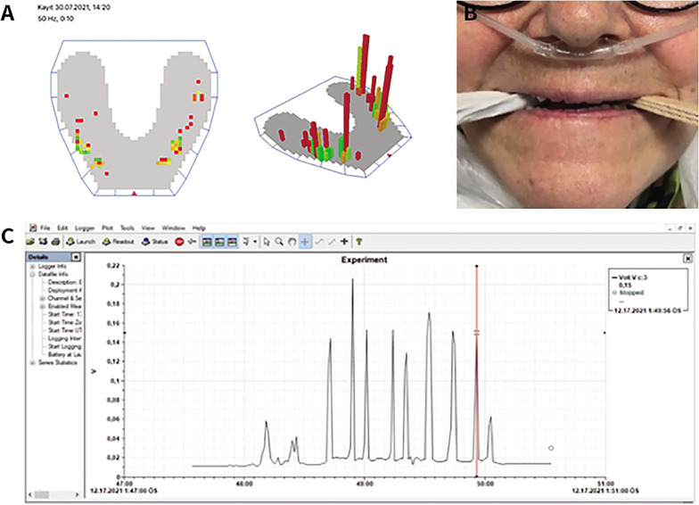 Evaluation of bite force, quality of life, and patients' satisfaction in elderly edentulous patients using implant overdentures.