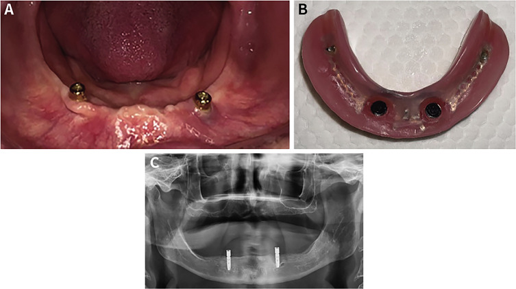 Evaluation of bite force, quality of life, and patients' satisfaction in elderly edentulous patients using implant overdentures.