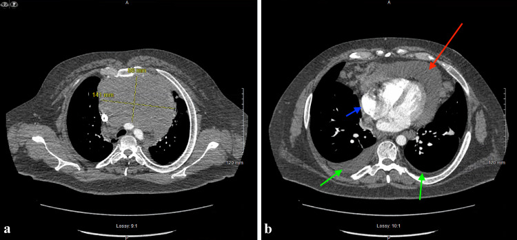 Primary Mediastinal B-Cell Lymphoma Presenting as Cardiac Tamponade.