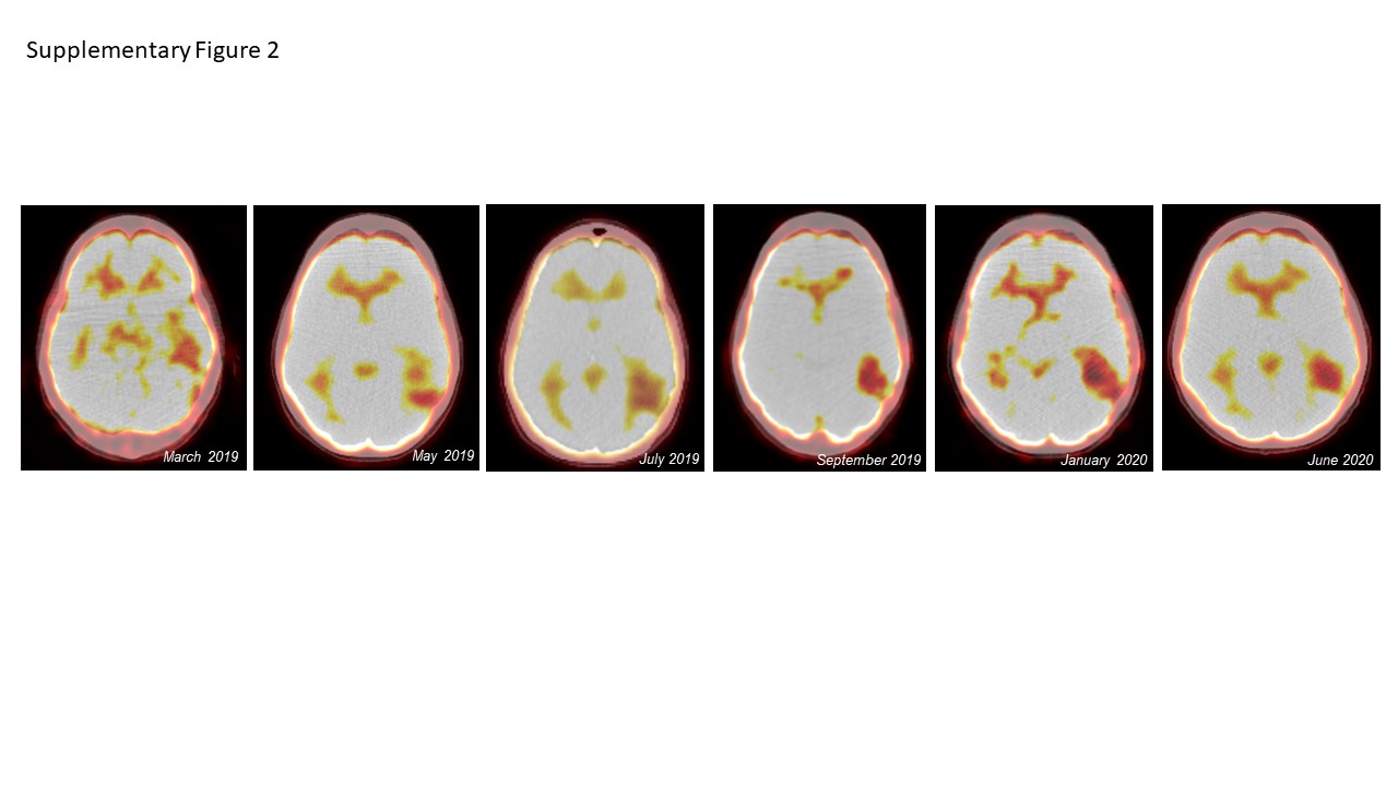 Multidisciplinary Care of a Large Brain Metastasis in a Patient with Hormone-Receptor-Positive Breast Cancer with Ataxia-Telangiectasia Mutation.