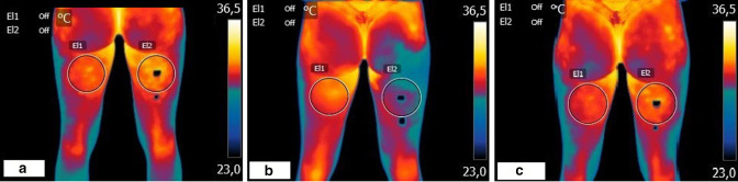 Medical ozone on hamstring injury in a professional athlete assessed by thermography: a clinical case report.