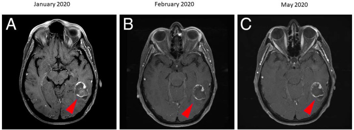 Multidisciplinary Care of a Large Brain Metastasis in a Patient with Hormone-Receptor-Positive Breast Cancer with Ataxia-Telangiectasia Mutation.