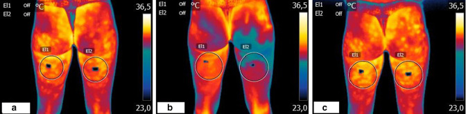 Medical ozone on hamstring injury in a professional athlete assessed by thermography: a clinical case report.