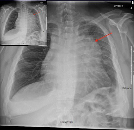 Primary Mediastinal B-Cell Lymphoma Presenting as Cardiac Tamponade.