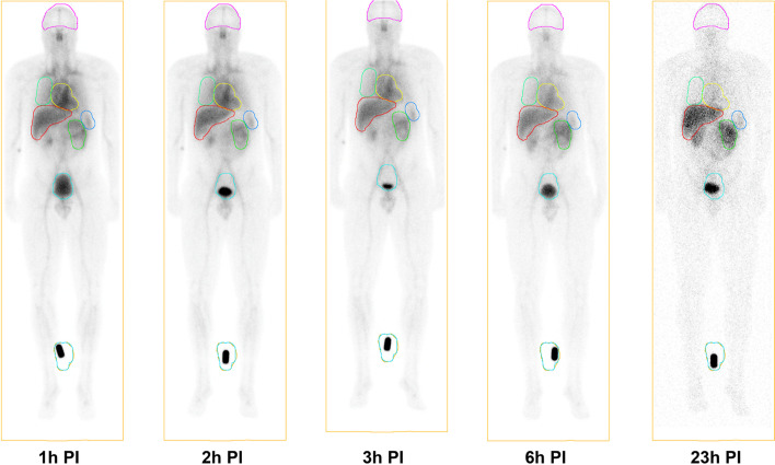 First-in-human study of a novel cell death tracer [99mTc]Tc-Duramycin: safety, biodistribution and radiation dosimetry in healthy volunteers