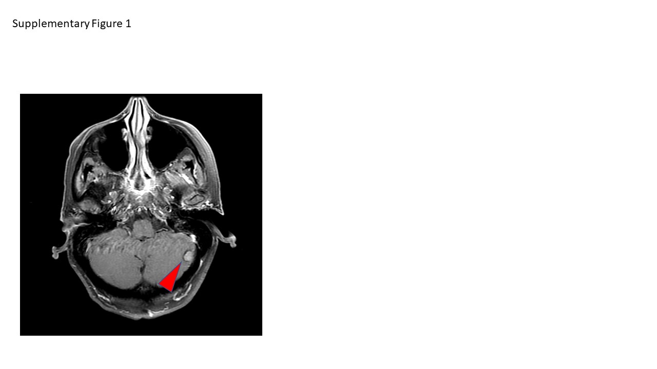 Multidisciplinary Care of a Large Brain Metastasis in a Patient with Hormone-Receptor-Positive Breast Cancer with Ataxia-Telangiectasia Mutation.