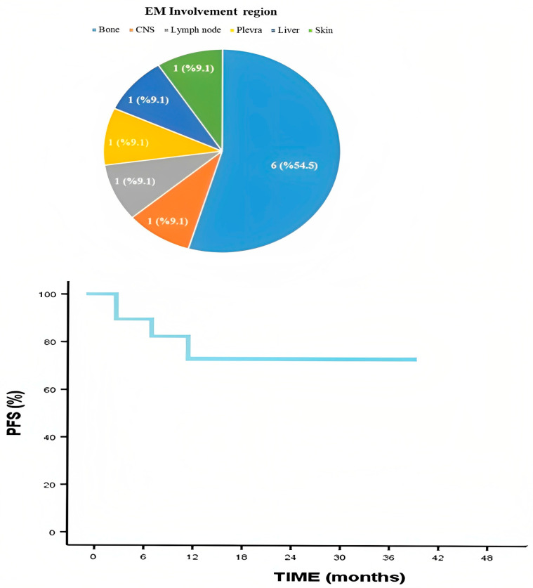 Efficacy of Bendamustine, Pomalidomide, and Dexamethasone (BPD) Regimen in Relapsed/Refractory Extramedullary Myeloma: A Retrospective Single-Centre Study, Real-Life Experience.