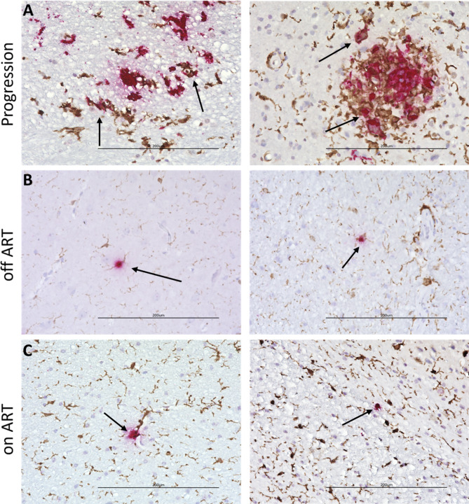 Transmitted/founder SHIV.D replicates in the brain, causes neuropathogenesis, and persists on combination antiretroviral therapy in rhesus macaques.