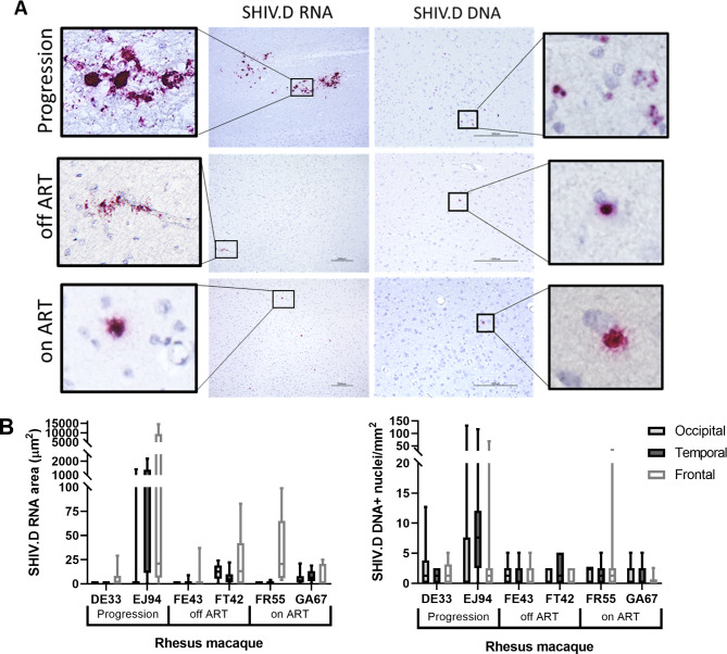 Transmitted/founder SHIV.D replicates in the brain, causes neuropathogenesis, and persists on combination antiretroviral therapy in rhesus macaques.