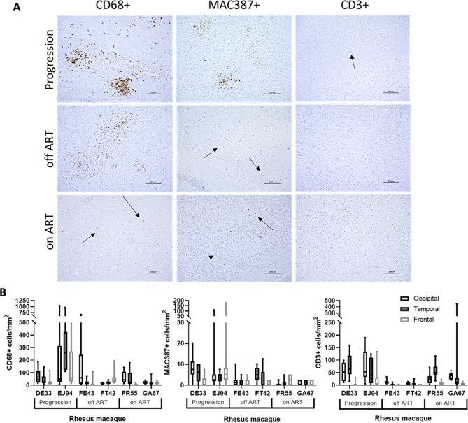 Transmitted/founder SHIV.D replicates in the brain, causes neuropathogenesis, and persists on combination antiretroviral therapy in rhesus macaques.