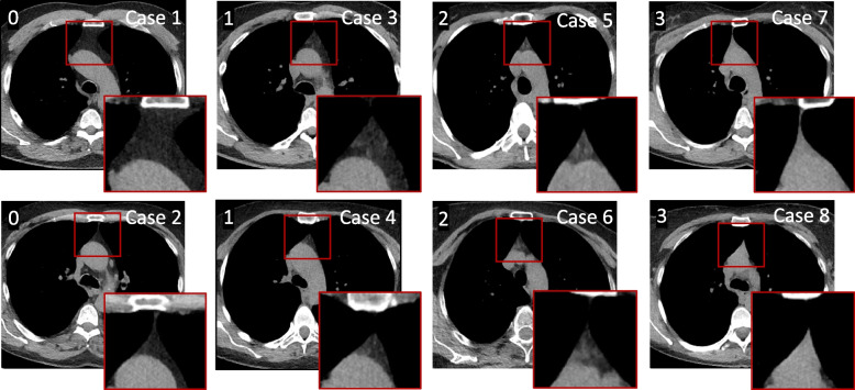 Complete fatty degeneration of thymus associates with male sex, obesity and loss of circulating naïve CD8<sup>+</sup> T cells in a Swedish middle-aged population.